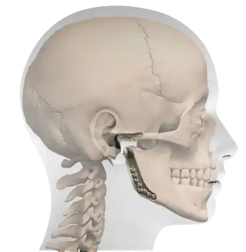 TMJ Joint Surgery​